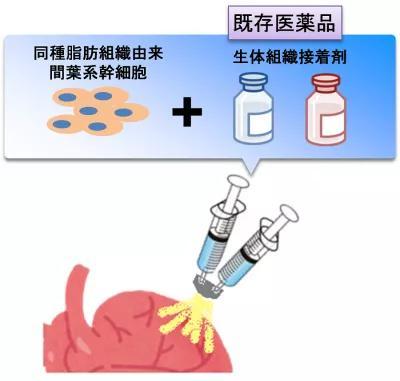 干細(xì)胞噴霧 大阪大學(xué)為心衰患者點(diǎn)亮新曙光